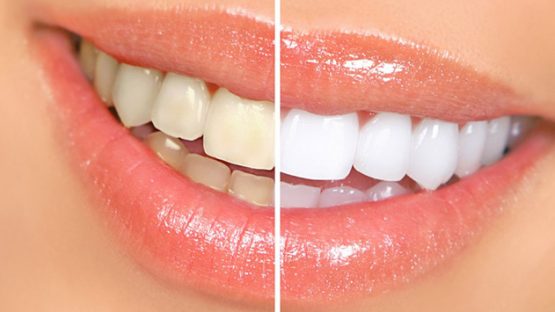 Teeth whitening for smile