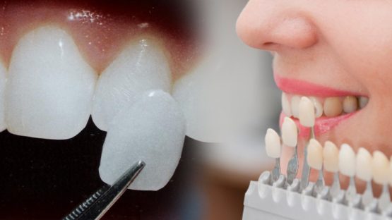 Procelain Veneer