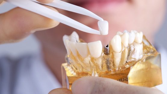 Dental implant